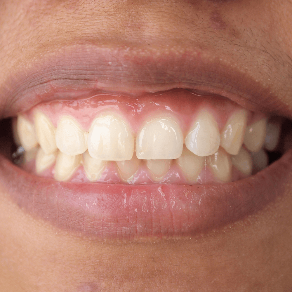How do I know if I have gum disease?
