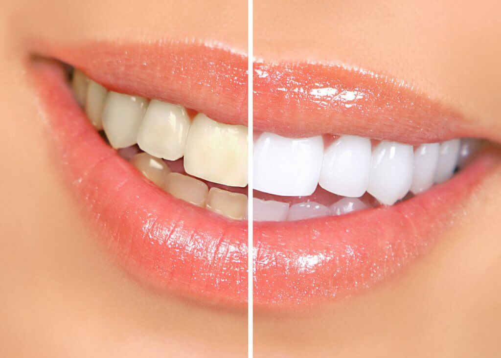 teeth whitening dentist sheffield