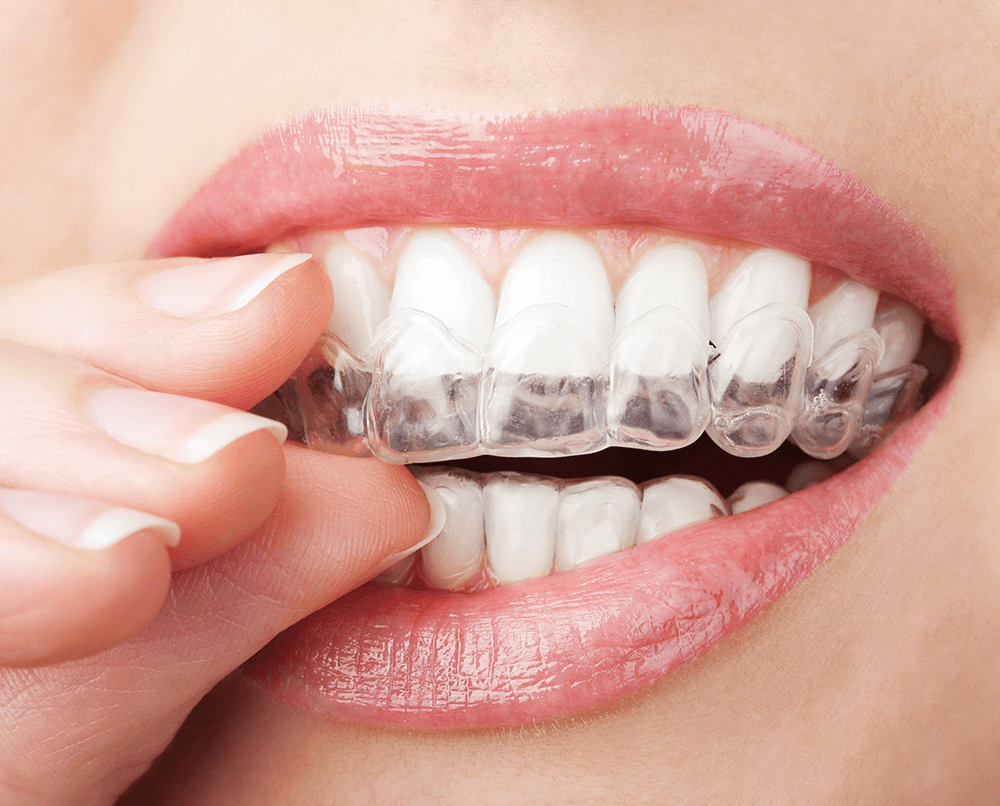 Teeth Whitening Tray Teeth Whitening Tray